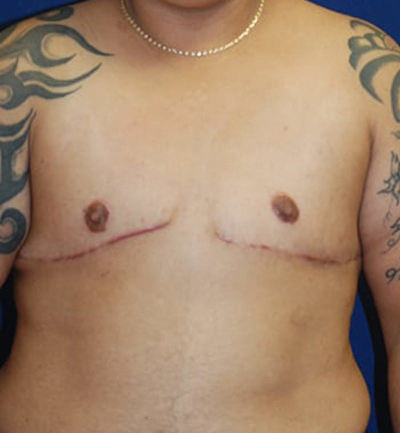 Masculinizing Surgery Before & After Gallery - Patient 675792 - Image 2