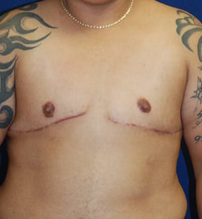 Masculinizing Surgery Before & After Gallery - Patient 675792 - Image 2