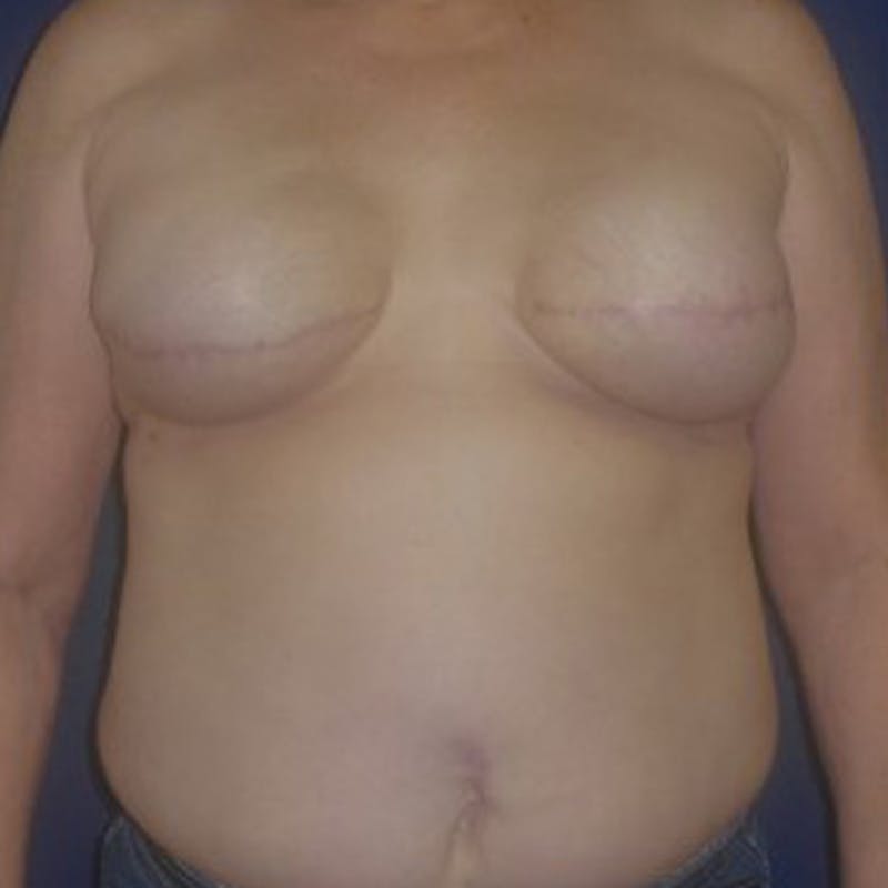 Breast Reconstruction with Implants Only Before & After Gallery - Patient 369945 - Image 1