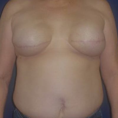 Breast Reconstruction with Implants Only Before & After Gallery - Patient 369945 - Image 1