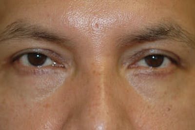 Eyelid Lift (Blepharoplasty) Before & After Gallery - Patient 328706 - Image 2