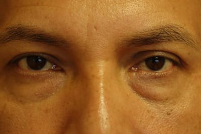 Eyelid Lift (Blepharoplasty) Before & After Gallery - Patient 328706 - Image 1