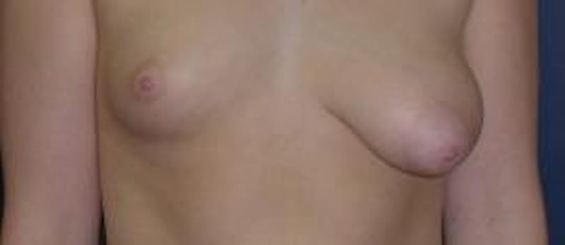 Breast Reconstruction with Implants Only Before & After Gallery - Patient 614631 - Image 1