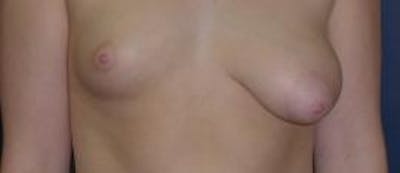 Breast Reconstruction with Implants Only Before & After Gallery - Patient 614631 - Image 1
