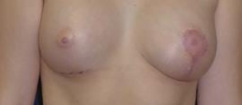 Breast Reconstruction with Implants Only Before & After Gallery - Patient 614631 - Image 2