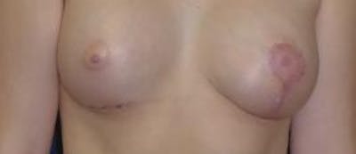 Breast Reconstruction with Implants Only Before & After Gallery - Patient 614631 - Image 2