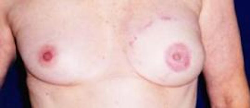 Breast Reconstruction with Autologous Tissue Before & After Gallery - Patient 295732 - Image 2