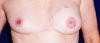 Breast Reconstruction with Autologous Tissue Before & After Gallery - Patient 295732 - Image 2