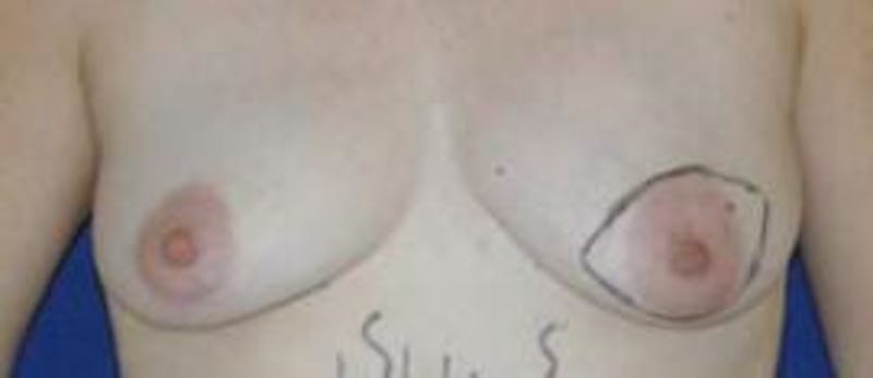 Breast Reconstruction with Autologous Tissue Before & After Gallery - Patient 307121 - Image 5