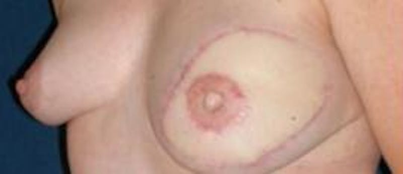 Breast Reconstruction with Autologous Tissue Before & After Gallery - Patient 307121 - Image 6