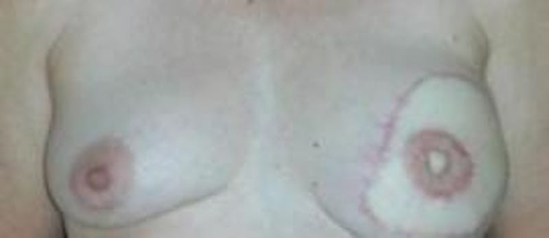 Breast Reconstruction with Autologous Tissue Before & After Gallery - Patient 307121 - Image 4