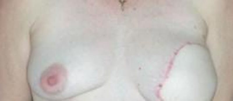 Breast Reconstruction with Autologous Tissue Before & After Gallery - Patient 307121 - Image 2
