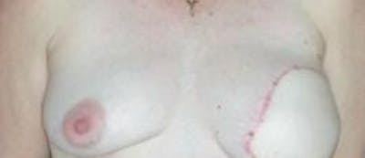Breast Reconstruction with Autologous Tissue Before & After Gallery - Patient 307121 - Image 2