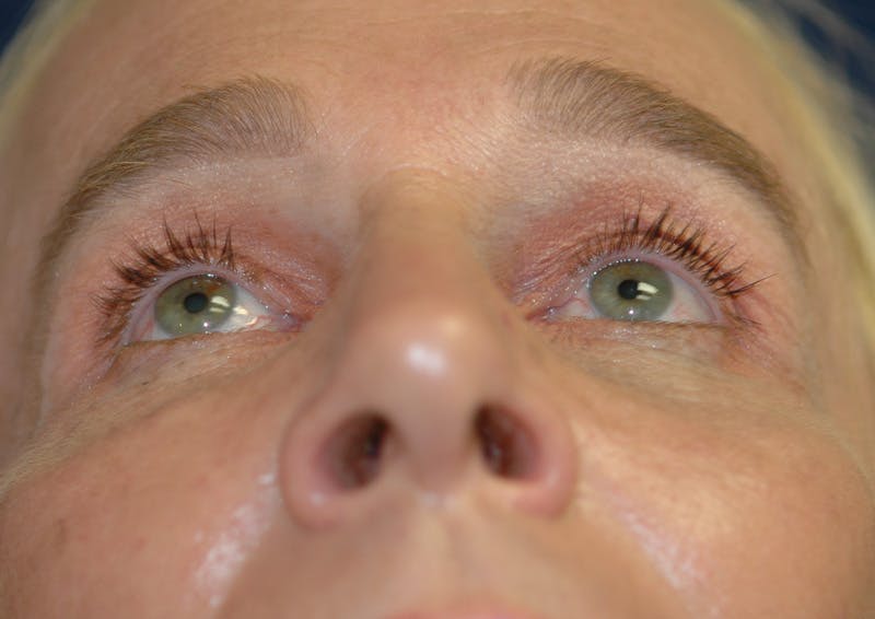 Feminizing Surgery Before & After Gallery - Patient 579279 - Image 6
