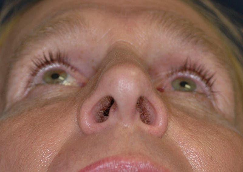 Feminizing Surgery Before & After Gallery - Patient 579279 - Image 5
