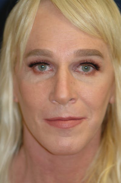 Feminizing Surgery Before & After Gallery - Patient 579279 - Image 2