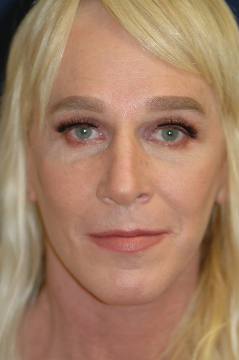 Feminizing Surgery Before & After Gallery - Patient 579279 - Image 2