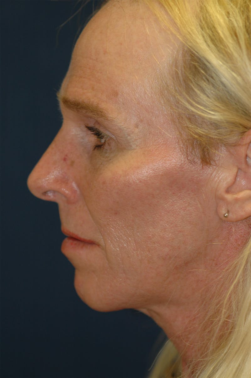 Feminizing Surgery Before & After Gallery - Patient 579279 - Image 3