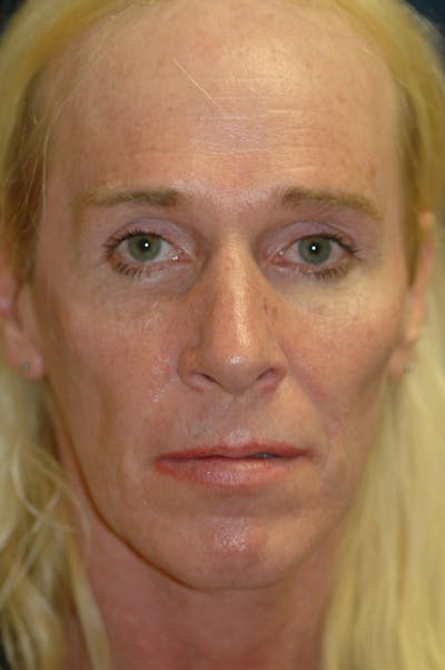 Feminizing Surgery Before & After Gallery - Patient 579279 - Image 1