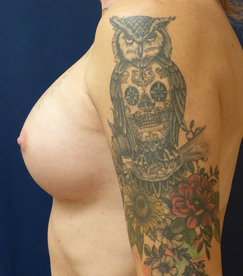 Feminizing Surgery Before & After Gallery - Patient 221505 - Image 6
