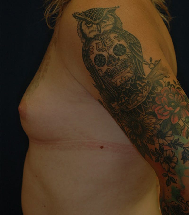 Feminizing Surgery Before & After Gallery - Patient 221505 - Image 5