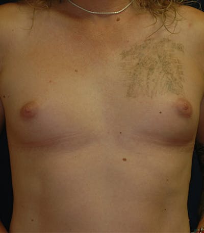 Feminizing Surgery Before & After Gallery - Patient 221505 - Image 1