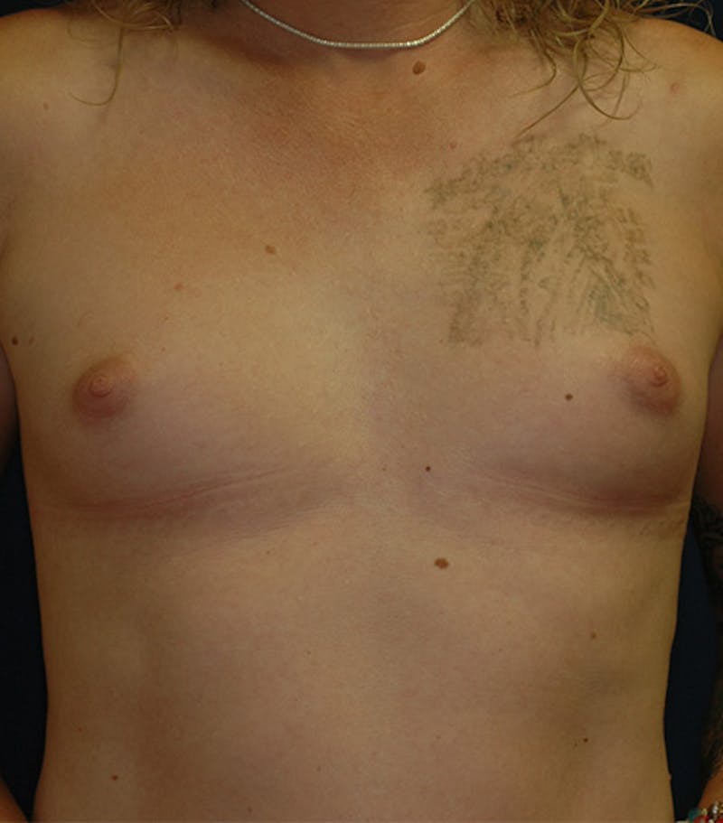 Feminizing Surgery Before & After Gallery - Patient 221505 - Image 1