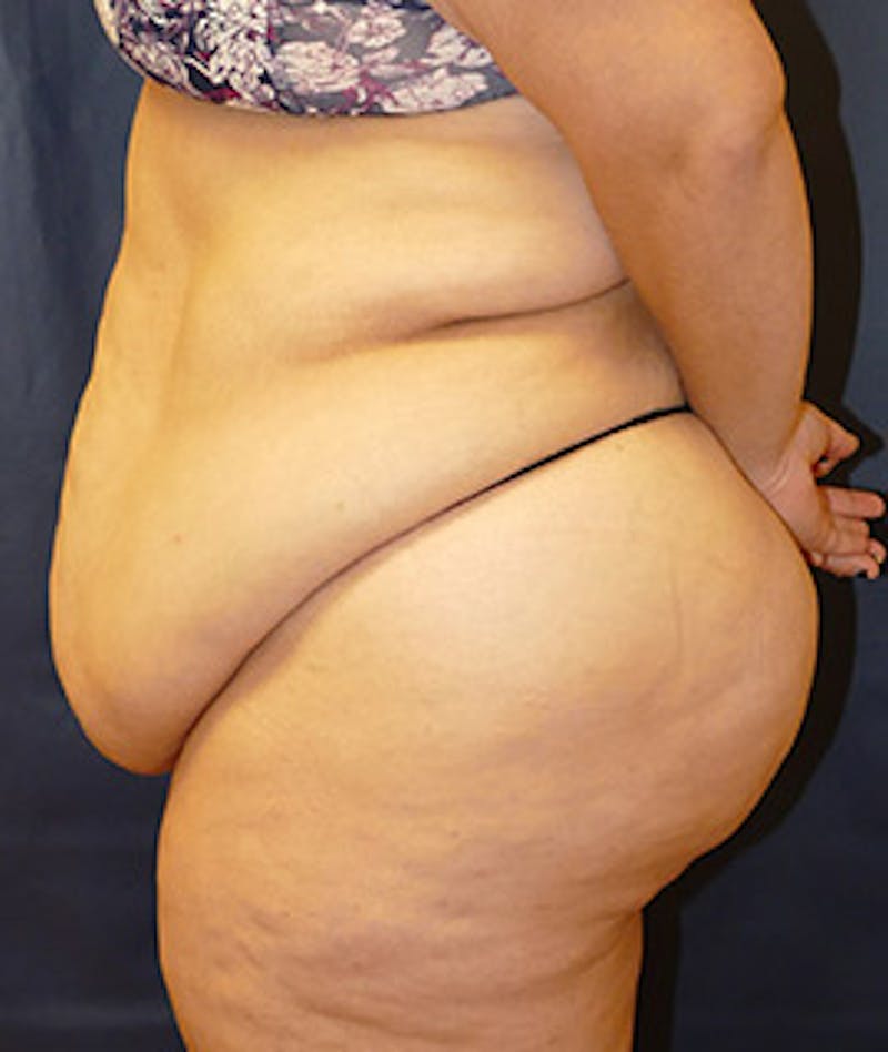 Tummy Tuck (Abdominoplasty) Before & After Gallery - Patient 119913 - Image 3
