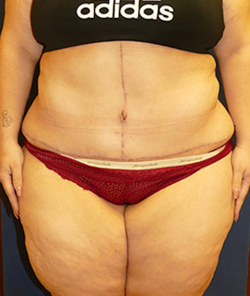 Tummy Tuck (Abdominoplasty) Before & After Gallery - Patient 119913 - Image 2