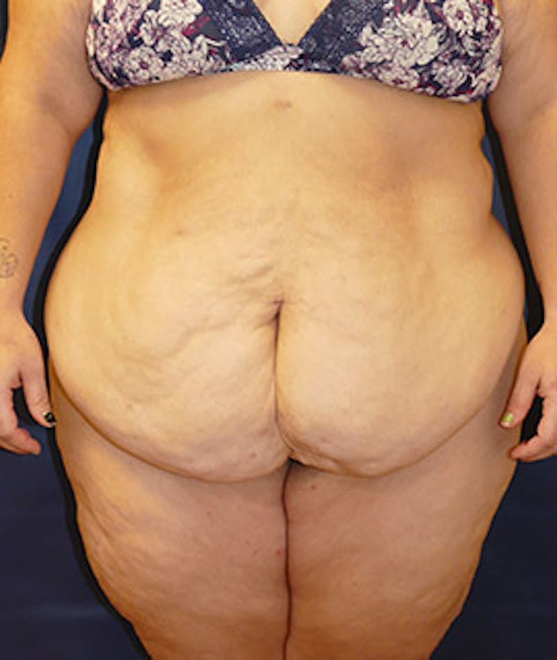 Tummy Tuck (Abdominoplasty) Before & After Gallery - Patient 119913 - Image 1