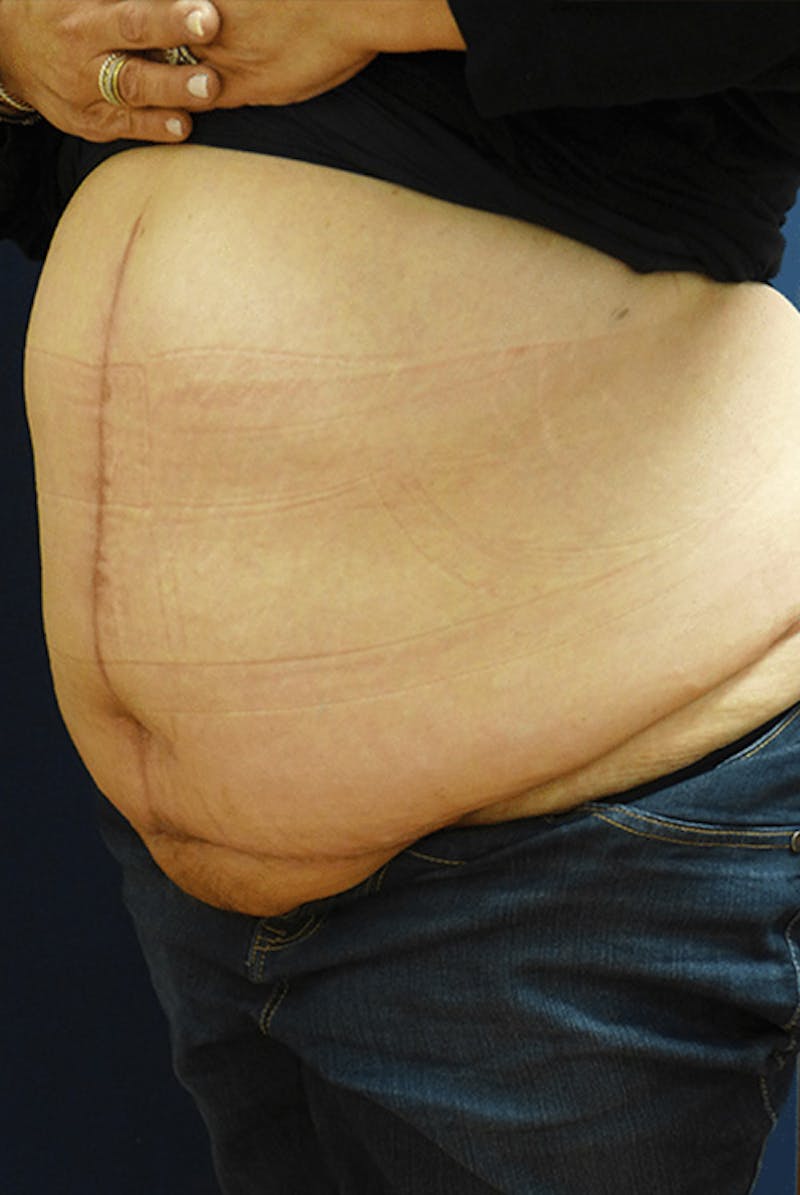 Tummy Tuck (Abdominoplasty) Before & After Gallery - Patient 340283 - Image 4