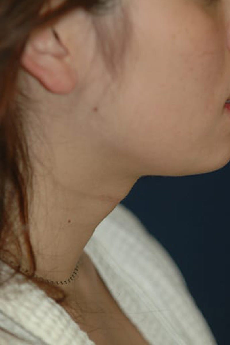Feminizing Surgery Before & After Gallery - Patient 206573 - Image 2