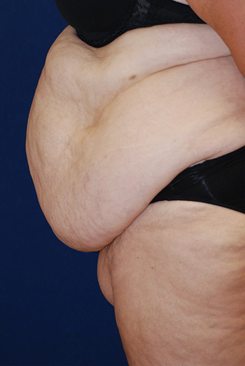 Tummy Tuck (Abdominoplasty) Before & After Gallery - Patient 340283 - Image 3