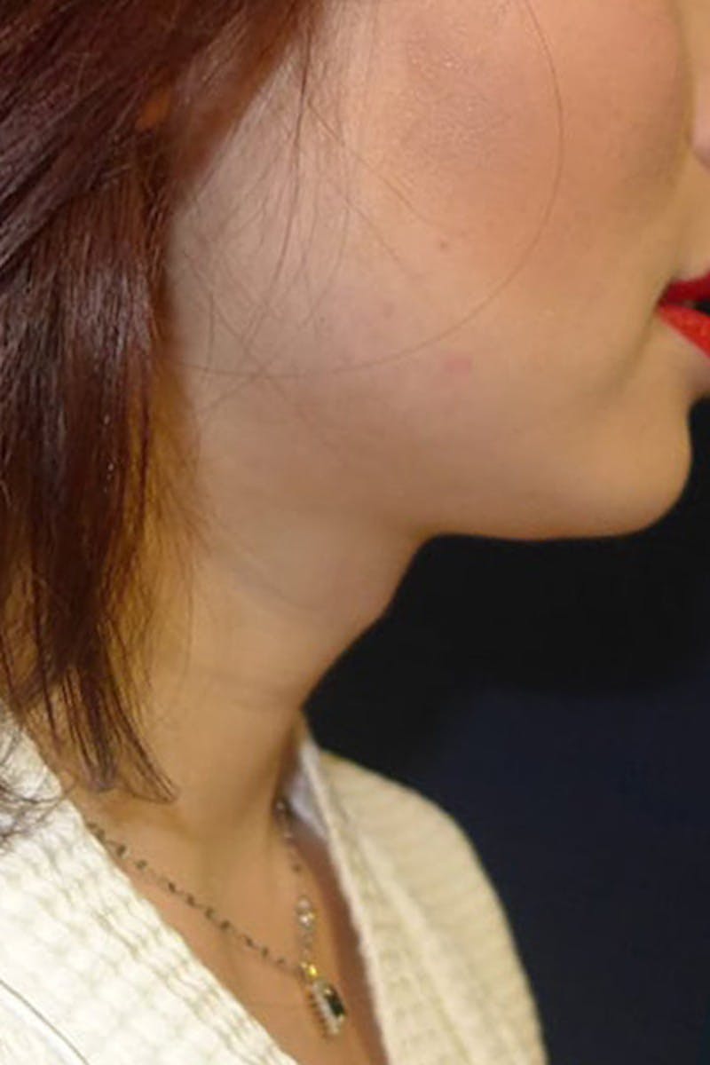 Feminizing Surgery Before & After Gallery - Patient 206573 - Image 1