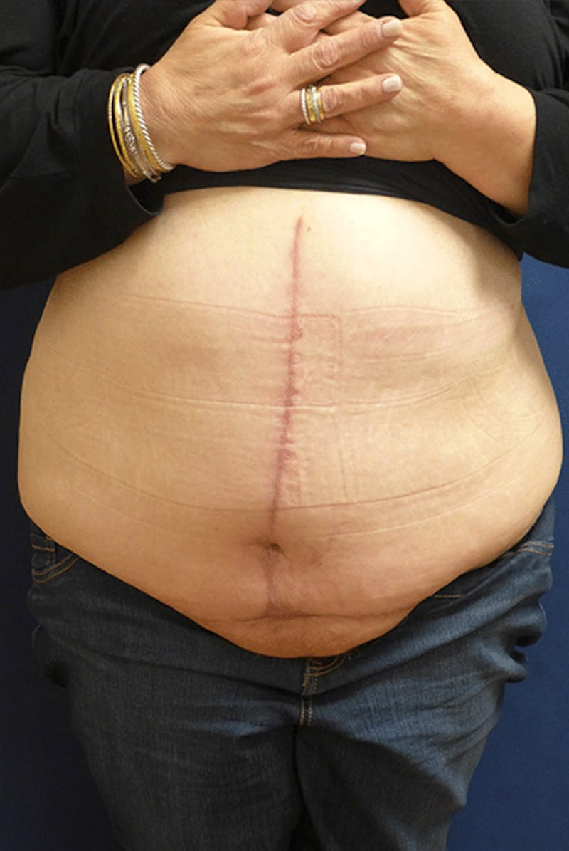 Tummy Tuck (Abdominoplasty) Before & After Gallery - Patient 340283 - Image 2