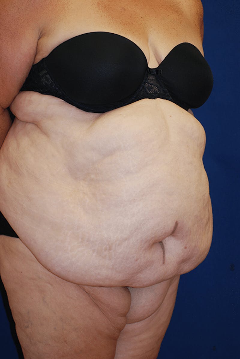 Tummy Tuck (Abdominoplasty) Before & After Gallery - Patient 340283 - Image 1