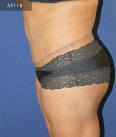 Tummy Tuck (Abdominoplasty) Before & After Gallery - Patient 304426 - Image 2