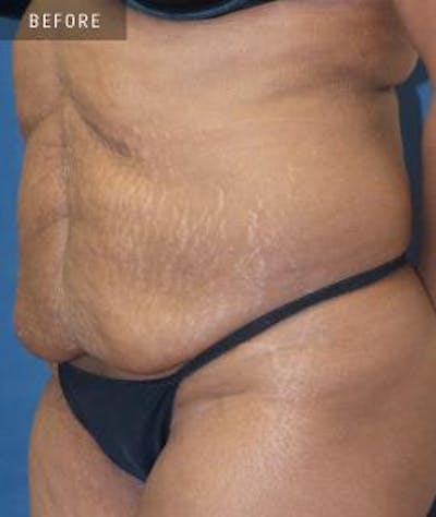 Tummy Tuck (Abdominoplasty) Before & After Gallery - Patient 304426 - Image 1