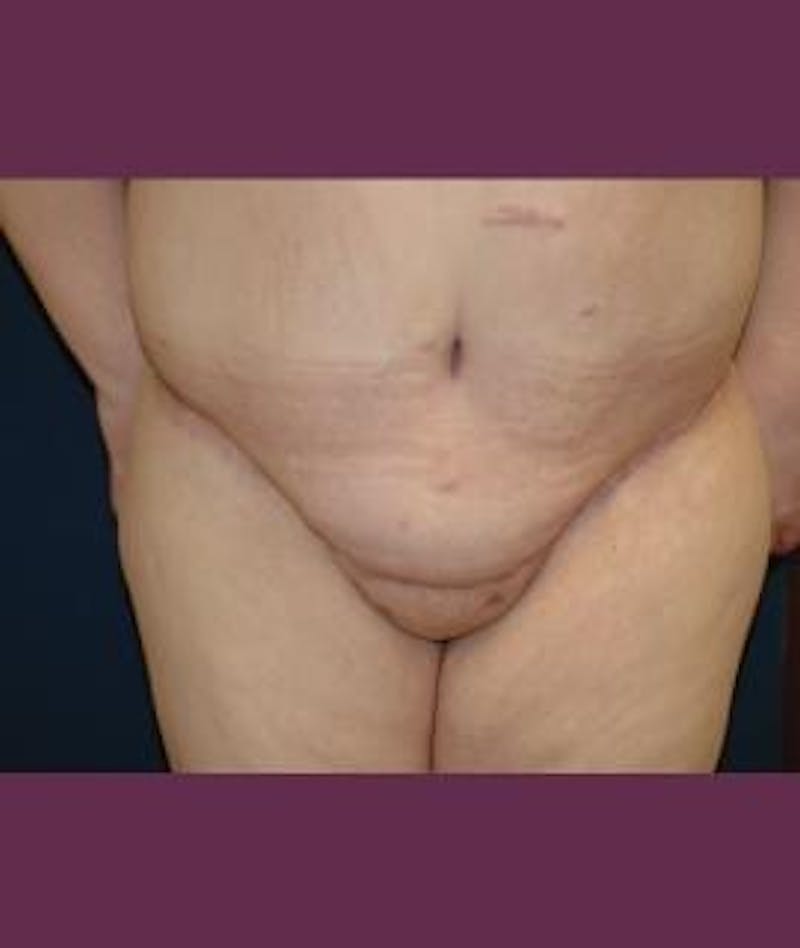 Tummy Tuck (Abdominoplasty) Before & After Gallery - Patient 349837 - Image 4