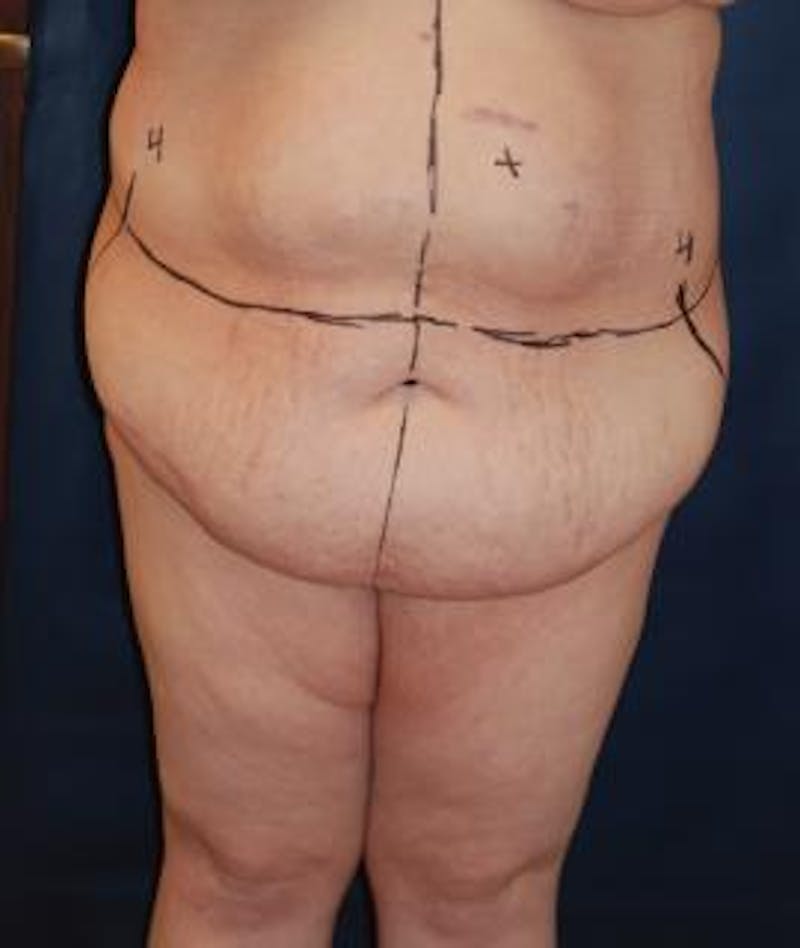 Tummy Tuck (Abdominoplasty) Before & After Gallery - Patient 349837 - Image 3