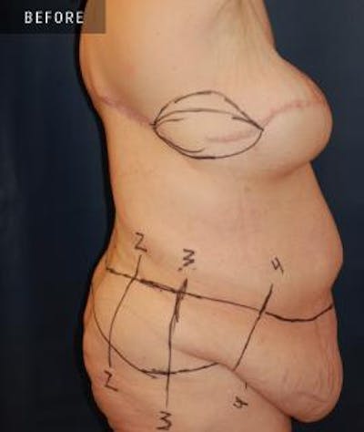 Tummy Tuck (Abdominoplasty) Before & After Gallery - Patient 349837 - Image 1