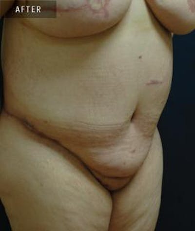 Tummy Tuck (Abdominoplasty) Before & After Gallery - Patient 349837 - Image 2