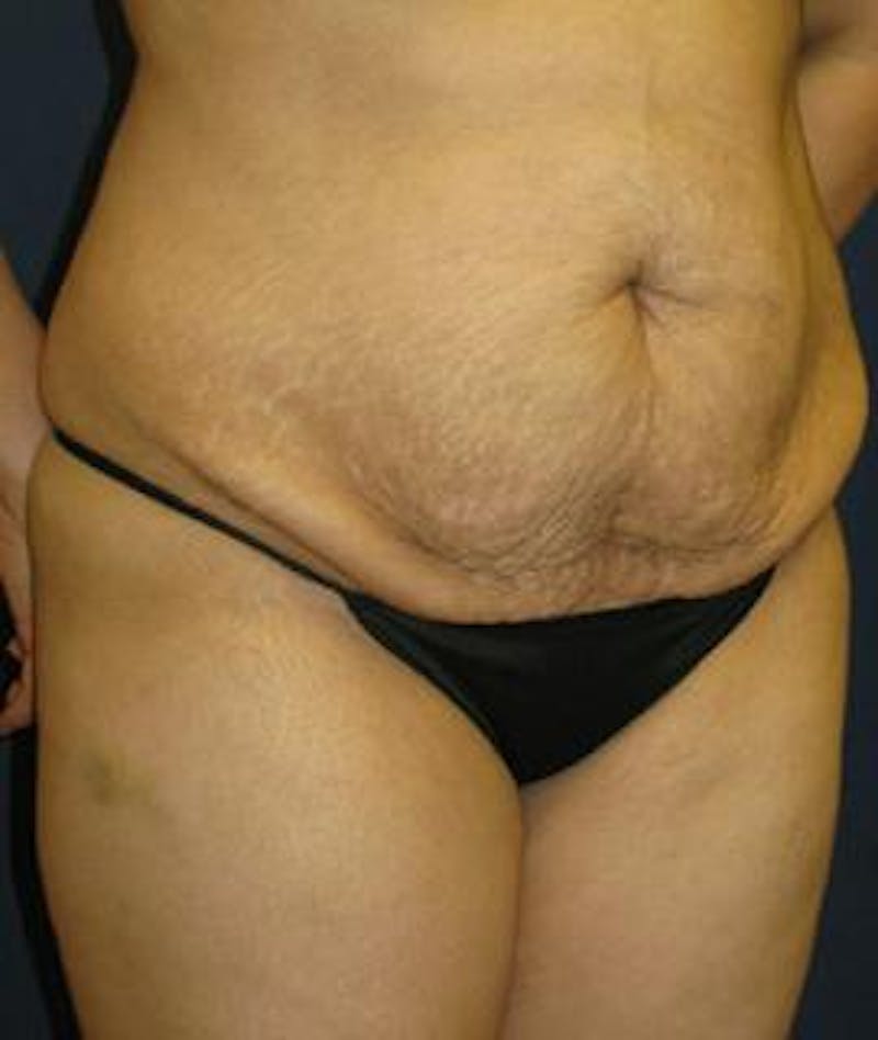 Tummy Tuck (Abdominoplasty) Before & After Gallery - Patient 264787 - Image 3