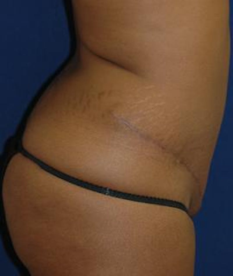 Tummy Tuck (Abdominoplasty) Before & After Gallery - Patient 298073 - Image 4