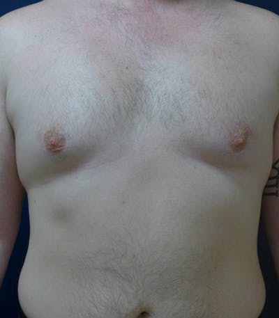 Male Subcutaneous Mastectomy (Gynecomastia) Before & After Gallery - Patient 321373 - Image 1