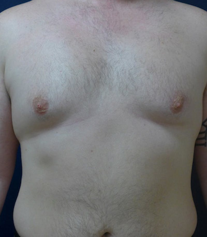 Male Subcutaneous Mastectomy (Gynecomastia) Before & After Gallery - Patient 321373 - Image 1