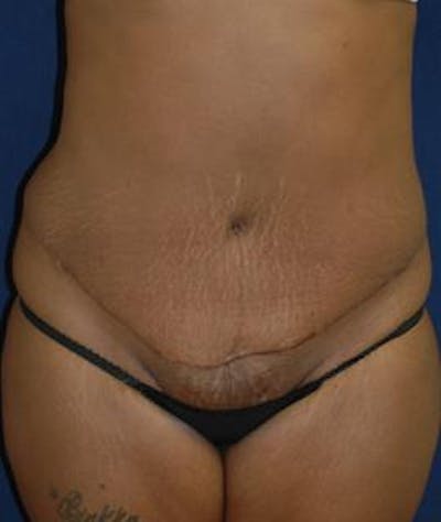 Tummy Tuck (Abdominoplasty) Before & After Gallery - Patient 298073 - Image 2