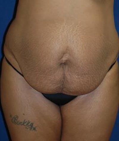 Tummy Tuck (Abdominoplasty) Before & After Gallery - Patient 298073 - Image 1