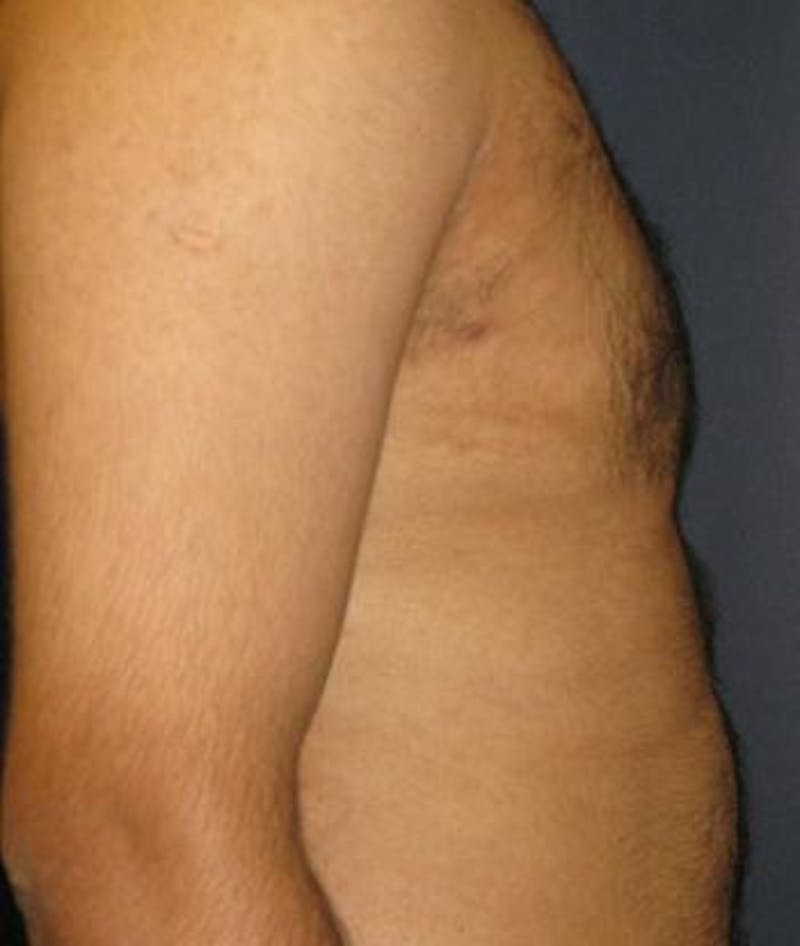 Male Subcutaneous Mastectomy (Gynecomastia) Before & After Gallery - Patient 186025 - Image 4