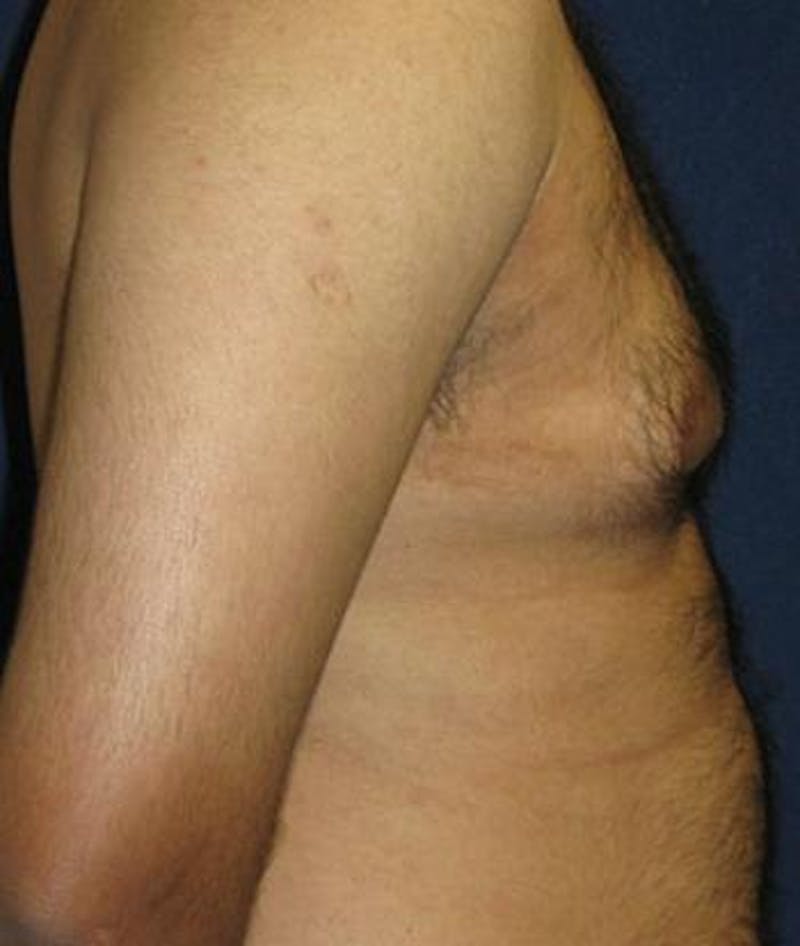 Male Subcutaneous Mastectomy (Gynecomastia) Before & After Gallery - Patient 186025 - Image 3